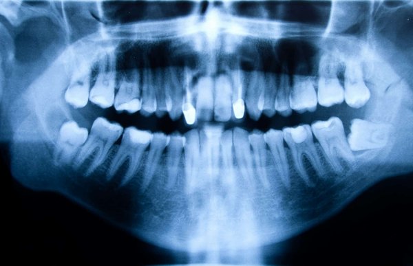 How Can Periodontal Health Be Maintained in Athletes to Avoid Impact on Performance?